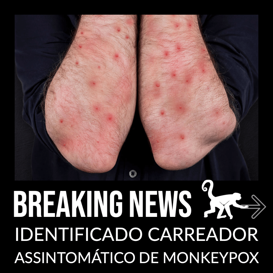 Identificado carreador assintomático de Monkeypox