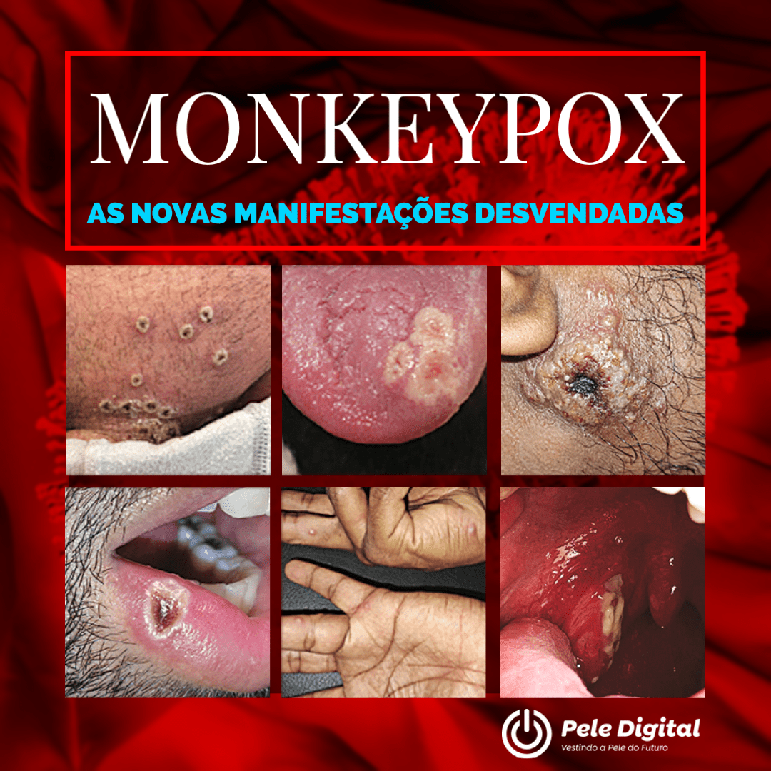 Quando suspeitar de Monkeypox?