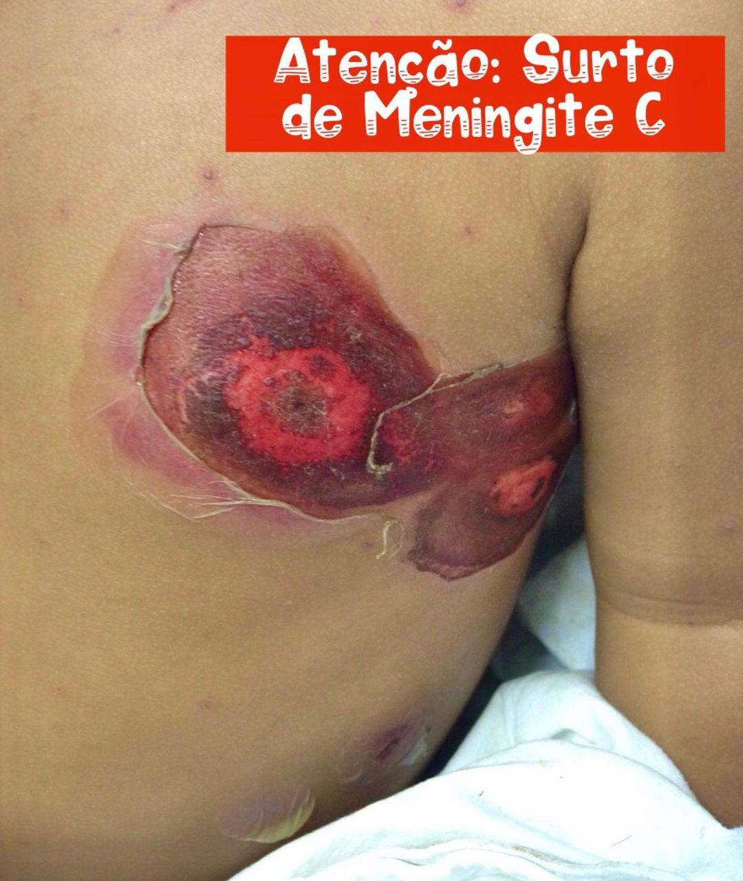 Atenção: Surto de Meningite C
