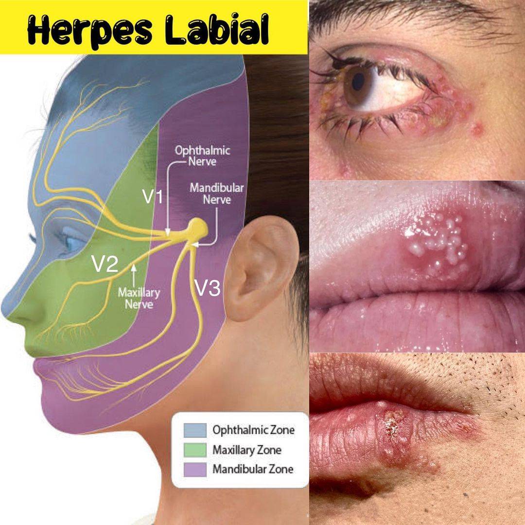 Você sabia que a Herpes Labial não reside nos lábios?